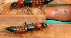 উত্তরবঙ্গে নাইরোবি ফ্লাই-এর আতঙ্ক, পুড়িয়ে দিচ্ছে ত্বক